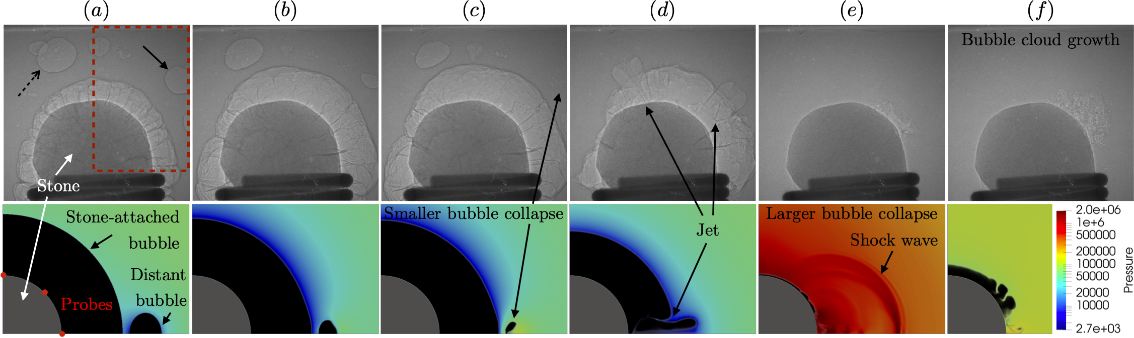 cavitation-bubbles-kedney-stone